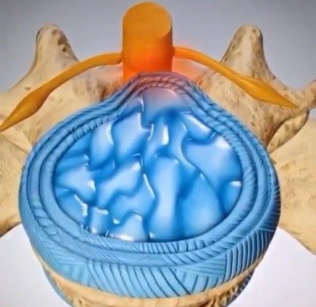 Cristales-sanadores-para-hernias-discales